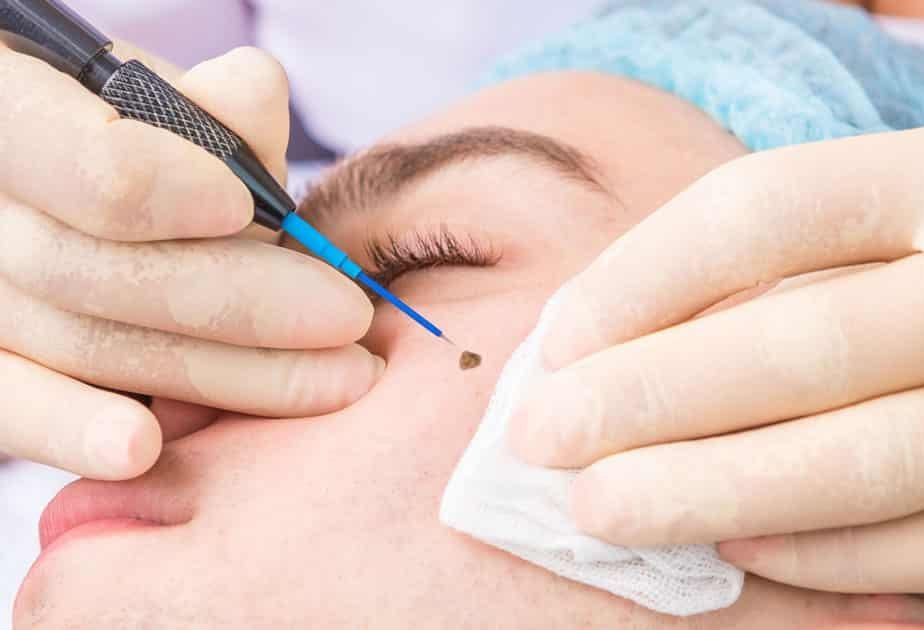 remove wart laser injection