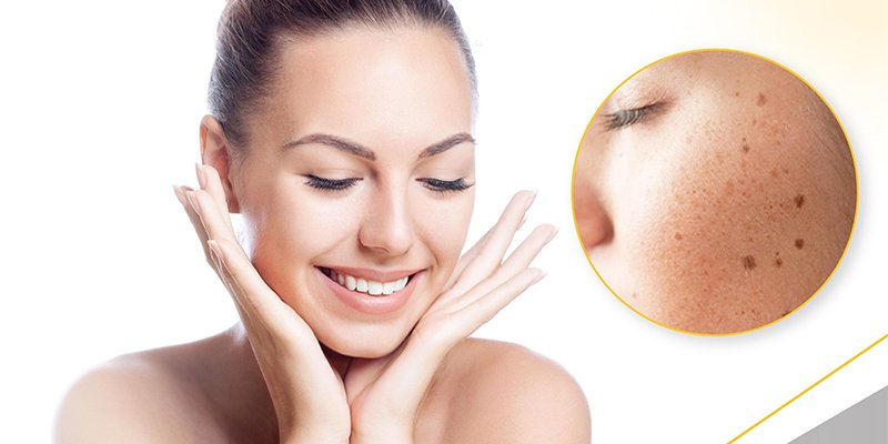 Pigmentation treatment girl