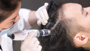 Best Hair Fall Specialist in Indore