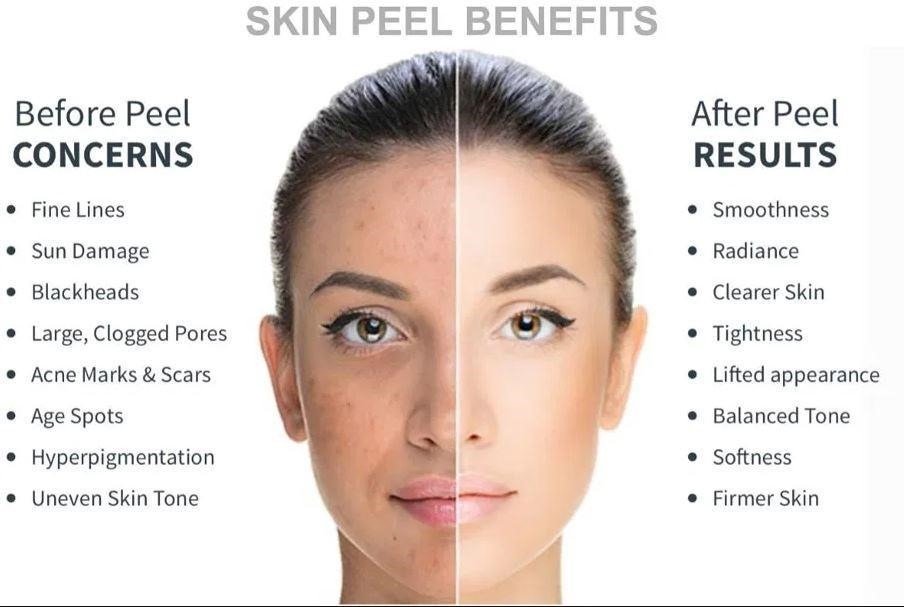 Chemical Peel For Pigmentation