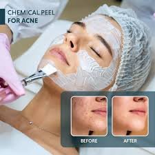 Chemical peel treatment for acne