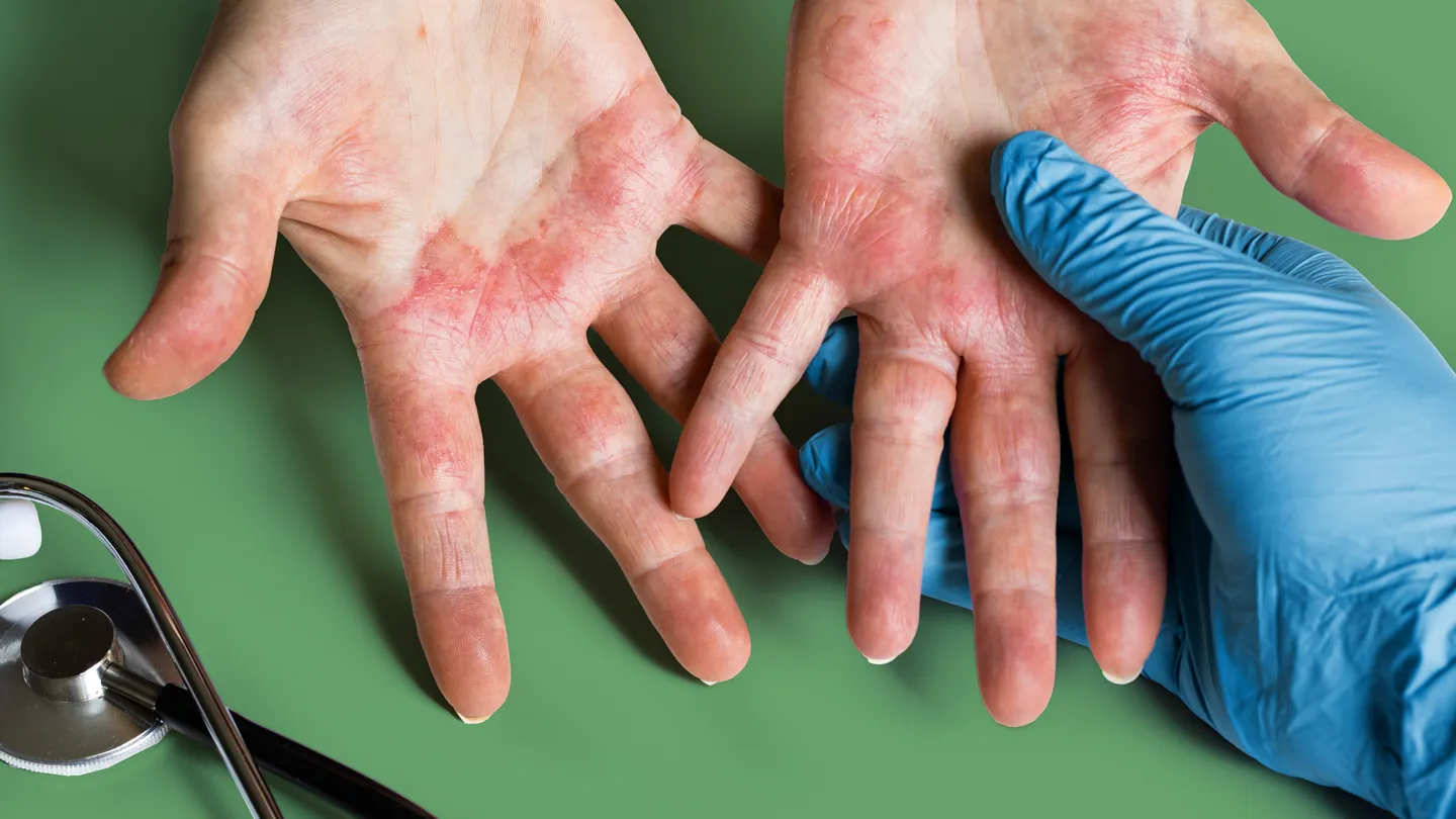 Eczema Treatment Dermatologist