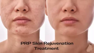 PRP Treatment For Skin In Gondia