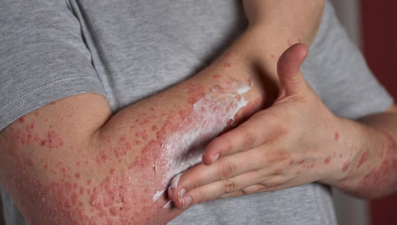 Psoriasis Treatment Doctor