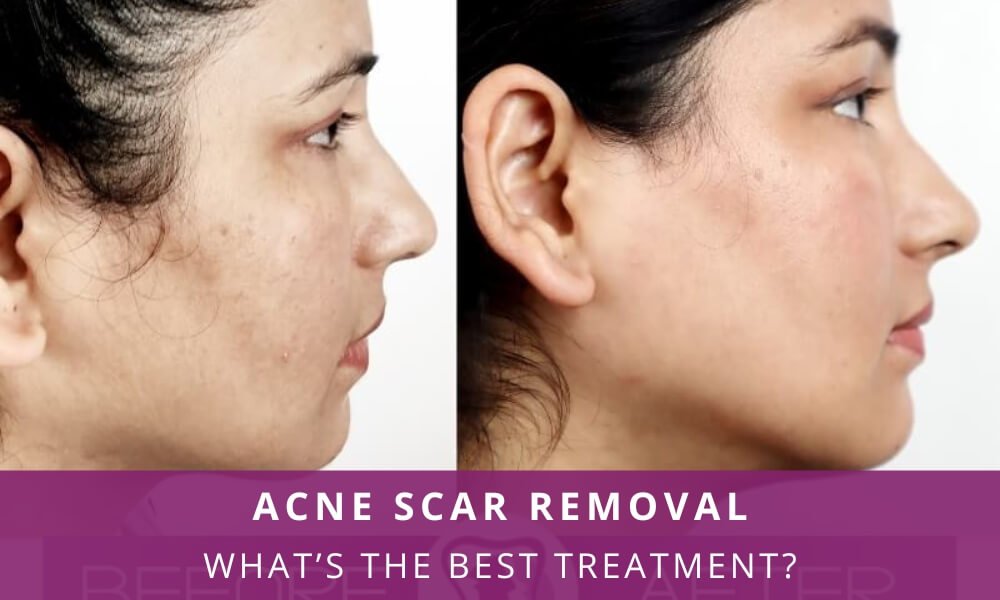 Scar Removal / Treatment In Nagpur