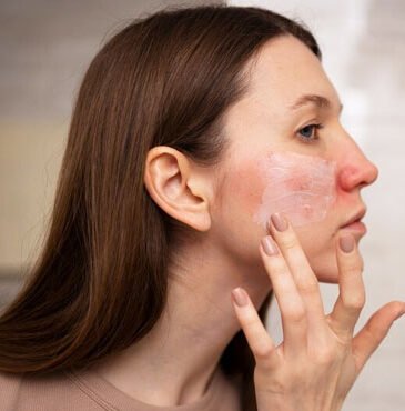 Skin Redness Treatment Doctor