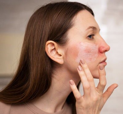 Skin Redness Treatment Doctor