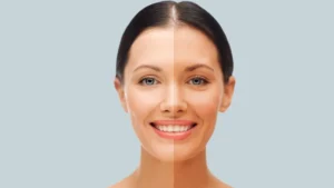 Skin Whitening Treatment In Jabalpur