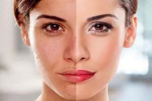 Skin Whitening Treatment In Narsinghpur