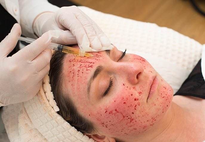 VAMPIRE FACIAL IN NAGPUR