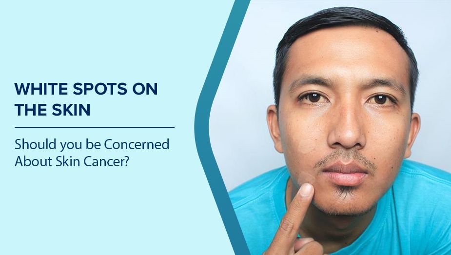 White Patch Treatment Doctor