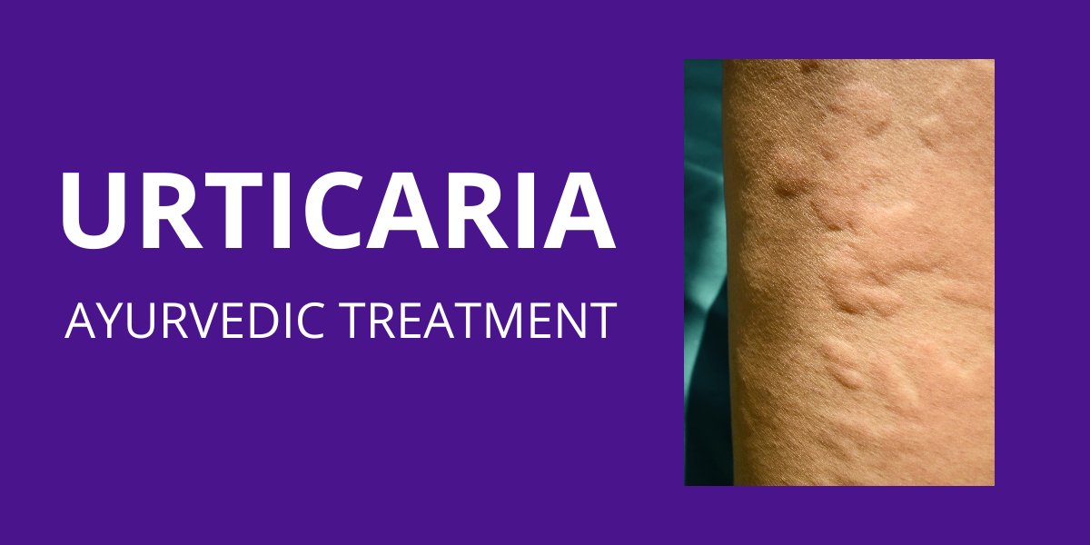 Urticaria treatment in nagpur